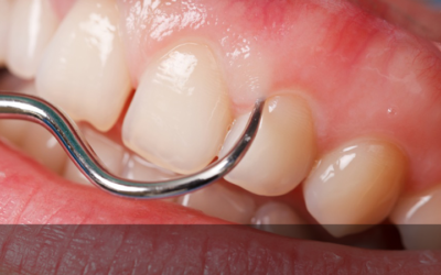 Doença Periodontal