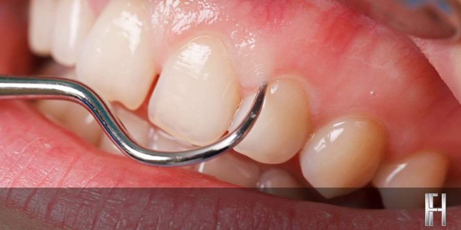 Doença Periodontal